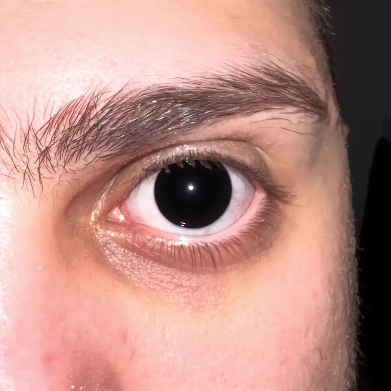 An eye turning completely black